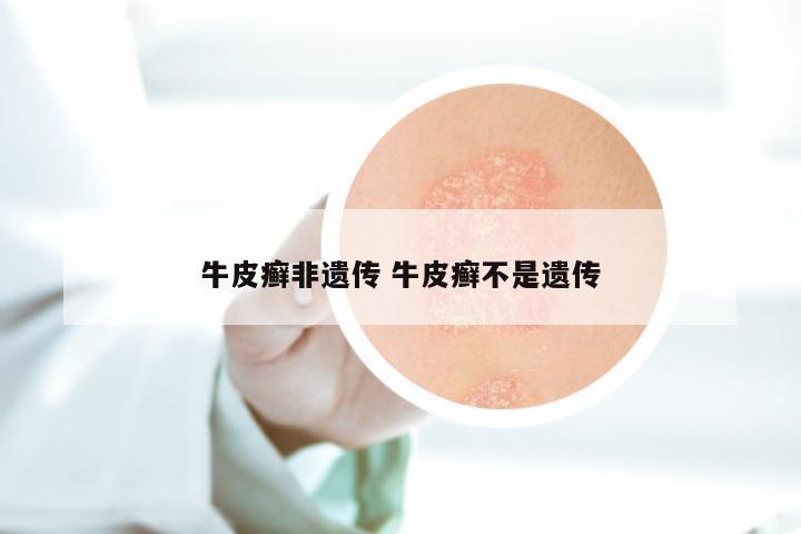 牛皮癣非遗传 牛皮癣不是遗传