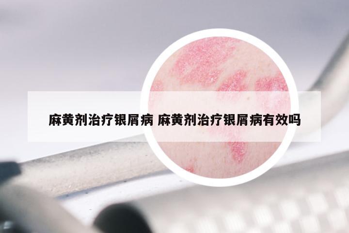 麻黄剂治疗银屑病 麻黄剂治疗银屑病有效吗
