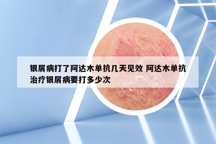 银屑病打了阿达木单抗几天见效 阿达木单抗治疗银屑病要打多少次