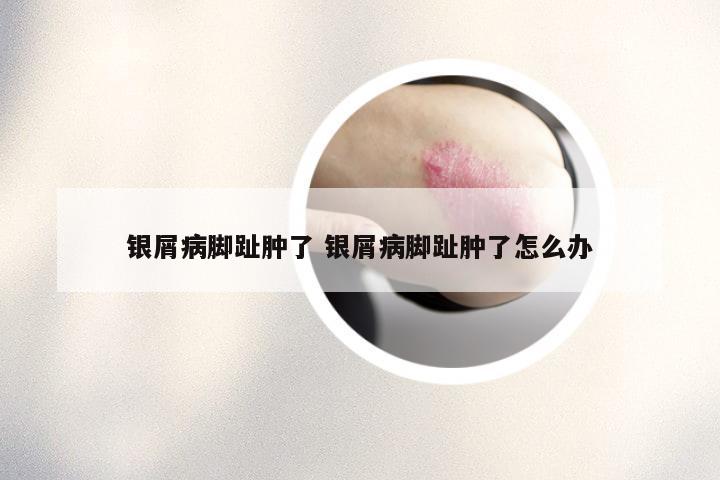 银屑病脚趾肿了 银屑病脚趾肿了怎么办