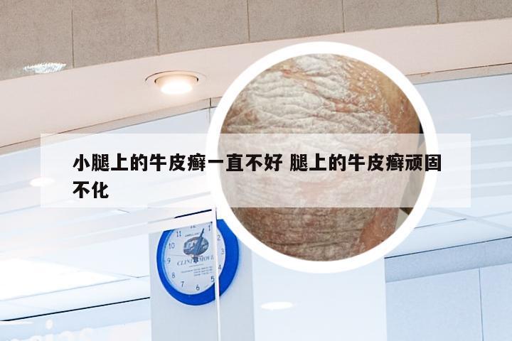 小腿上的牛皮癣一直不好 腿上的牛皮癣顽固不化