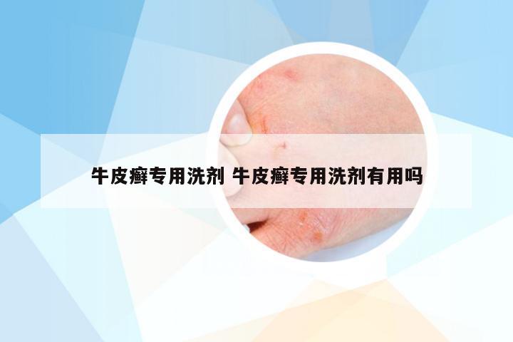 牛皮癣专用洗剂 牛皮癣专用洗剂有用吗
