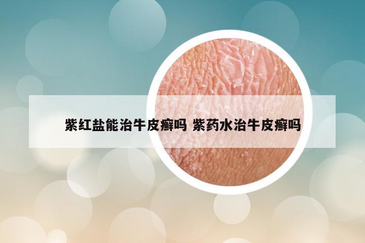 紫红盐能治牛皮癣吗 紫药水治牛皮癣吗