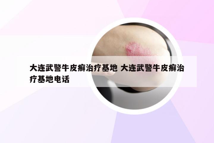 大连武警牛皮癣治疗基地 大连武警牛皮癣治疗基地电话