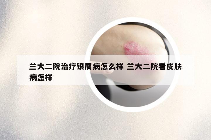 兰大二院治疗银屑病怎么样 兰大二院看皮肤病怎样