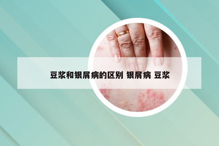 豆浆和银屑病的区别 银屑病 豆浆