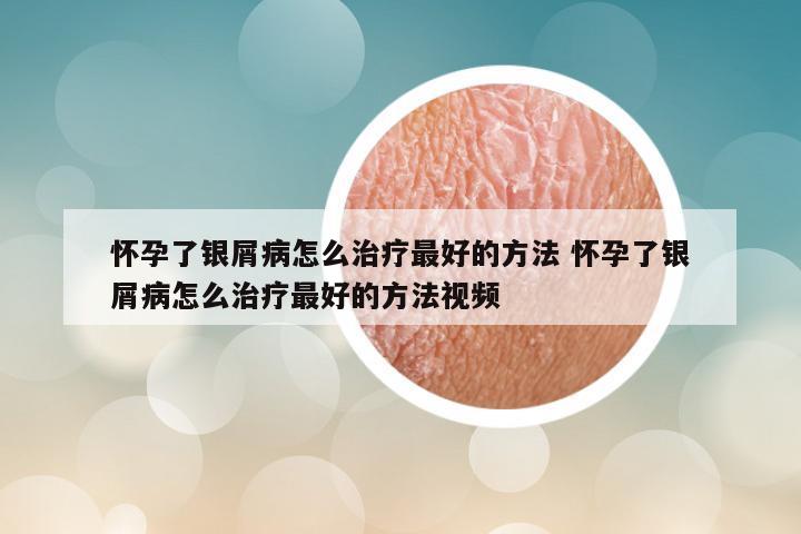 怀孕了银屑病怎么治疗最好的方法 怀孕了银屑病怎么治疗最好的方法视频