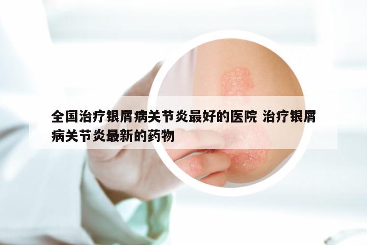 全国治疗银屑病关节炎最好的医院 治疗银屑病关节炎最新的药物