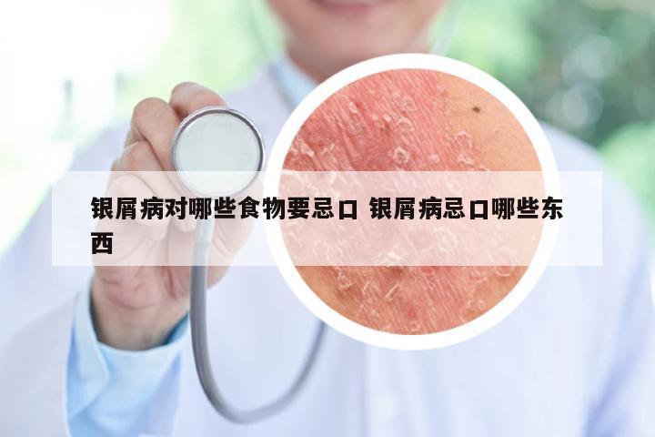 银屑病对哪些食物要忌口 银屑病忌口哪些东西