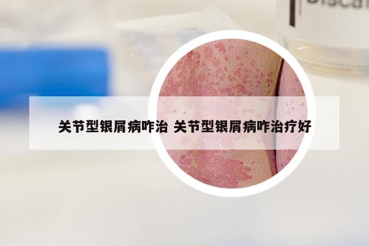 关节型银屑病咋治 关节型银屑病咋治疗好