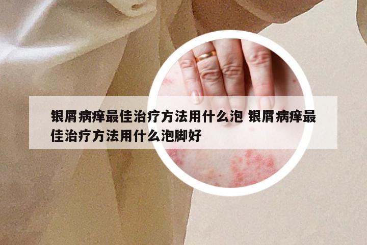 银屑病痒最佳治疗方法用什么泡 银屑病痒最佳治疗方法用什么泡脚好