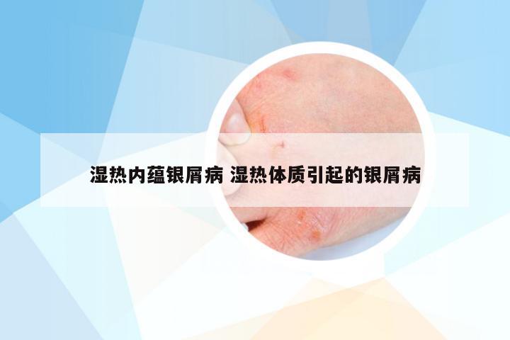 湿热内蕴银屑病 湿热体质引起的银屑病