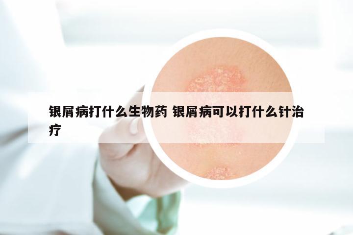 银屑病打什么生物药 银屑病可以打什么针治疗