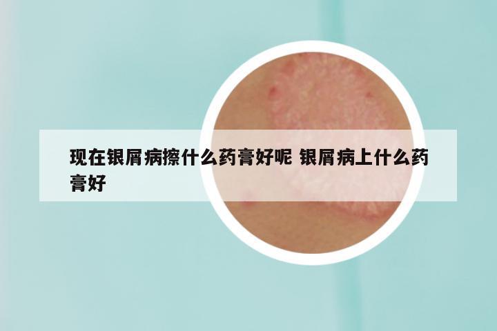 现在银屑病擦什么药膏好呢 银屑病上什么药膏好