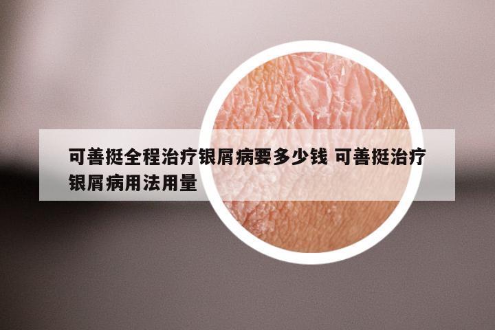 可善挺全程治疗银屑病要多少钱 可善挺治疗银屑病用法用量