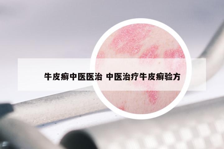 牛皮癣中医医治 中医治疗牛皮癣验方