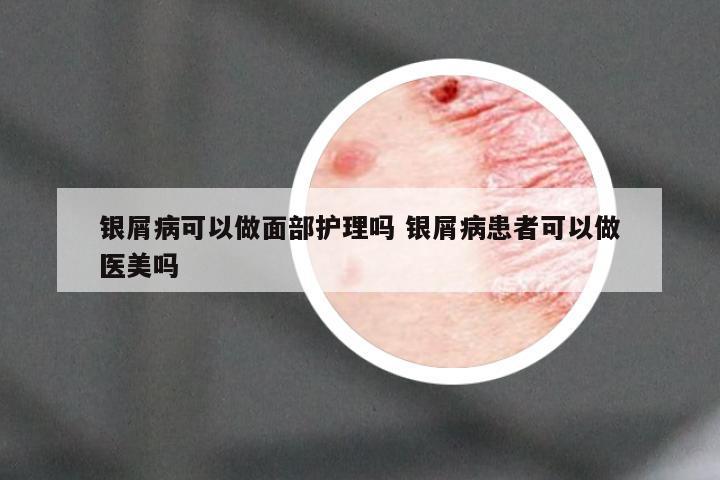 银屑病可以做面部护理吗 银屑病患者可以做医美吗