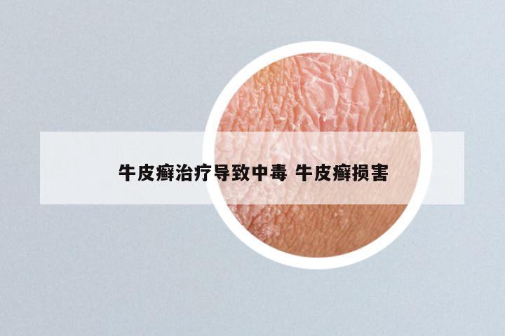 牛皮癣治疗导致中毒 牛皮癣损害
