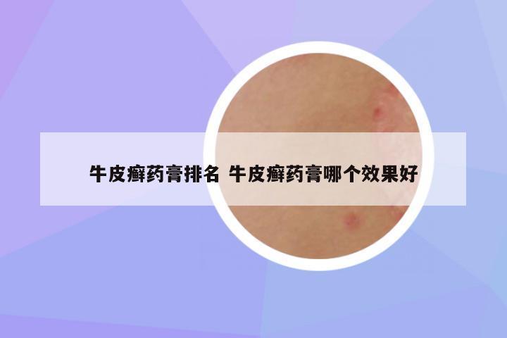 牛皮癣药膏排名 牛皮癣药膏哪个效果好