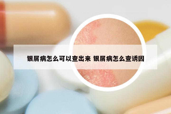 银屑病怎么可以查出来 银屑病怎么查诱因