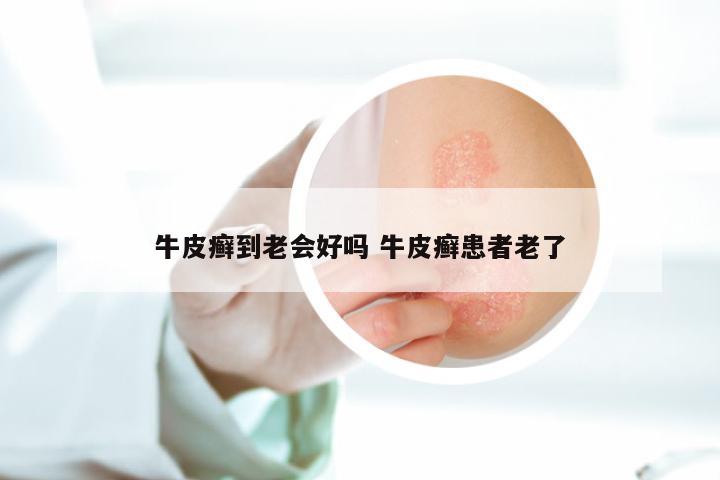 牛皮癣到老会好吗 牛皮癣患者老了