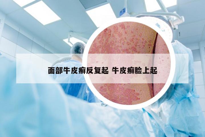 面部牛皮癣反复起 牛皮癣脸上起