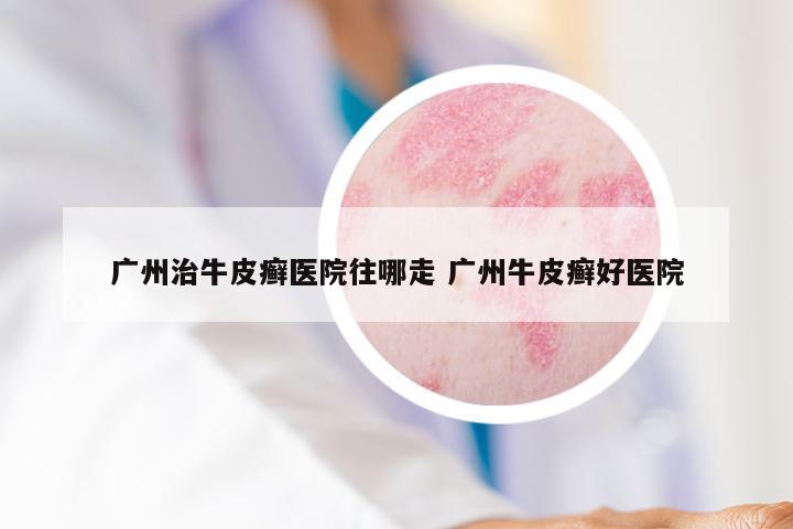 广州治牛皮癣医院往哪走 广州牛皮癣好医院