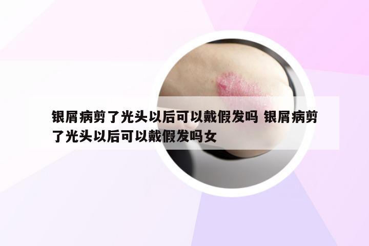 银屑病剪了光头以后可以戴假发吗 银屑病剪了光头以后可以戴假发吗女