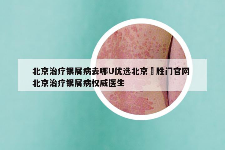 北京治疗银屑病去哪U优选北京徳胜门官网 北京治疗银屑病权威医生