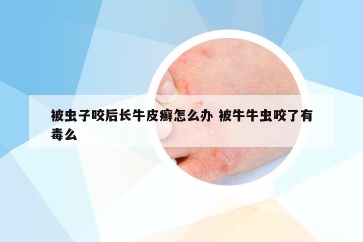 被虫子咬后长牛皮癣怎么办 被牛牛虫咬了有毒么