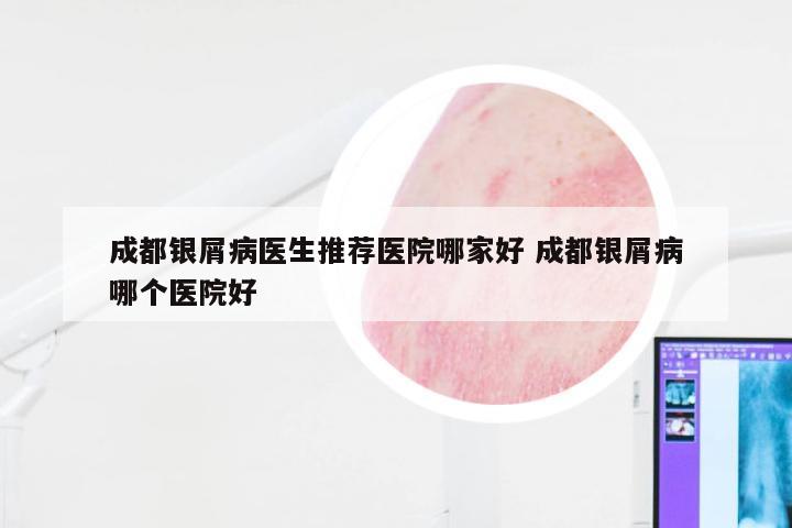 成都银屑病医生推荐医院哪家好 成都银屑病哪个医院好