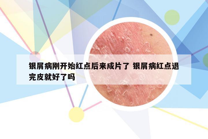 银屑病刚开始红点后来成片了 银屑病红点退完皮就好了吗