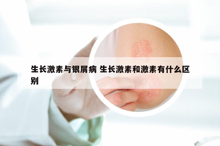 生长激素与银屑病 生长激素和激素有什么区别