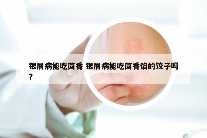 银屑病能吃茴香 银屑病能吃茴香馅的饺子吗?