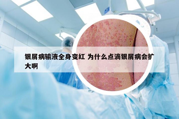 银屑病输液全身变红 为什么点滴银屑病会扩大啊