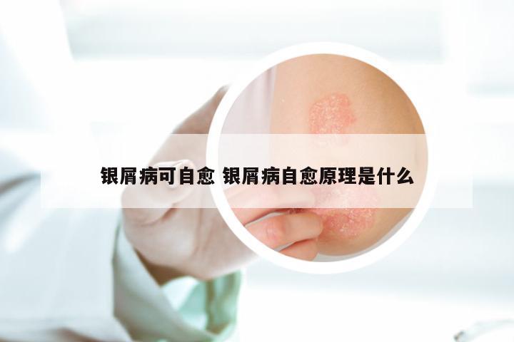 银屑病可自愈 银屑病自愈原理是什么