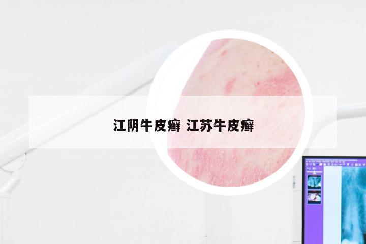 江阴牛皮癣 江苏牛皮癣