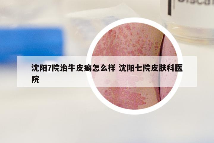 沈阳7院治牛皮癣怎么样 沈阳七院皮肤科医院
