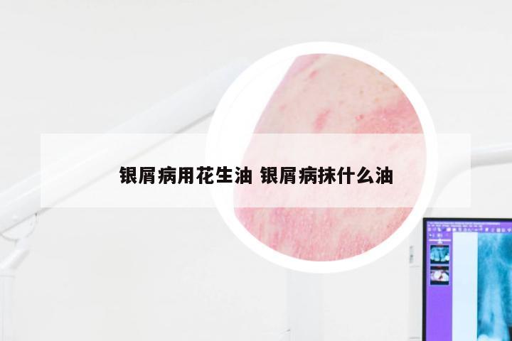 银屑病用花生油 银屑病抹什么油