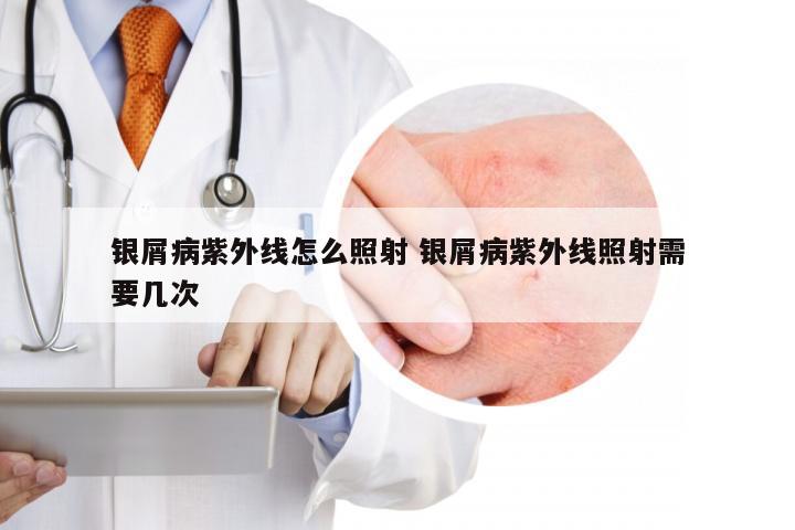 银屑病紫外线怎么照射 银屑病紫外线照射需要几次