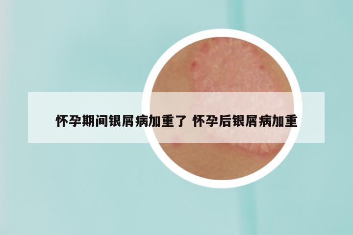 怀孕期间银屑病加重了 怀孕后银屑病加重