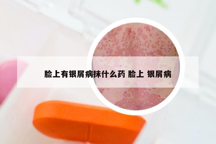 脸上有银屑病抹什么药 脸上 银屑病