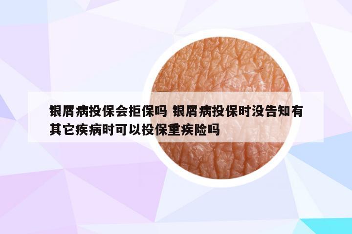 银屑病投保会拒保吗 银屑病投保时没告知有其它疾病时可以投保重疾险吗