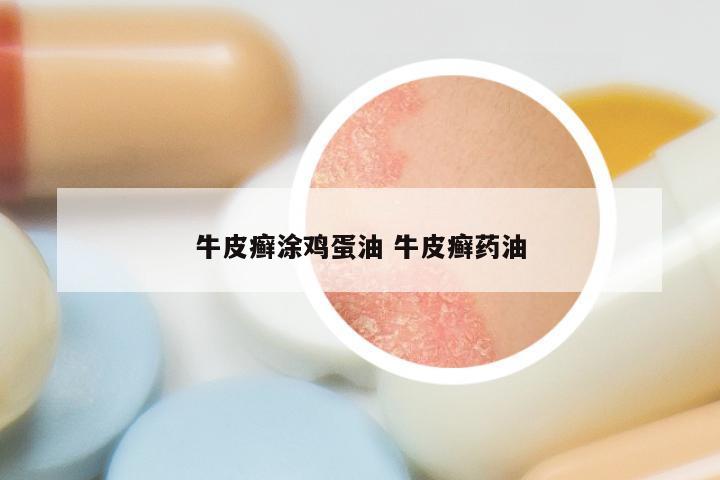 牛皮癣涂鸡蛋油 牛皮癣药油