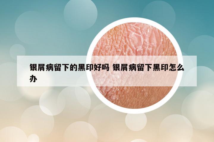 银屑病留下的黑印好吗 银屑病留下黑印怎么办