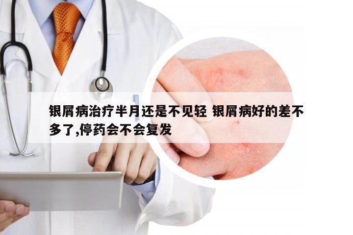 银屑病治疗半月还是不见轻 银屑病好的差不多了,停药会不会复发