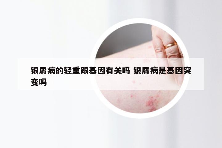 银屑病的轻重跟基因有关吗 银屑病是基因突变吗