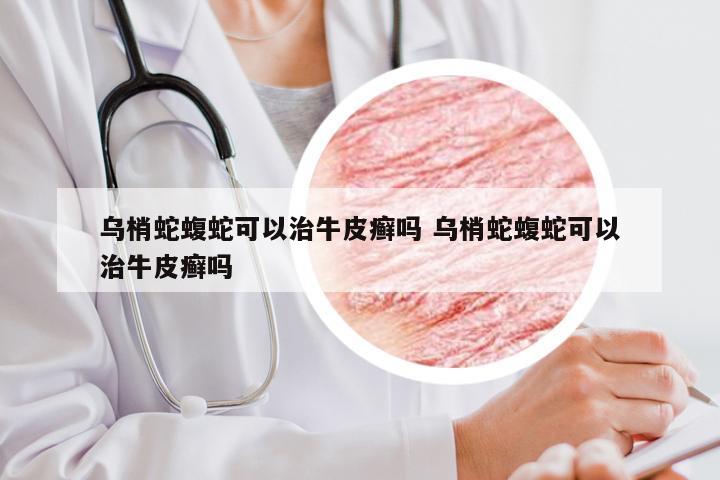 乌梢蛇蝮蛇可以治牛皮癣吗 乌梢蛇蝮蛇可以治牛皮癣吗
