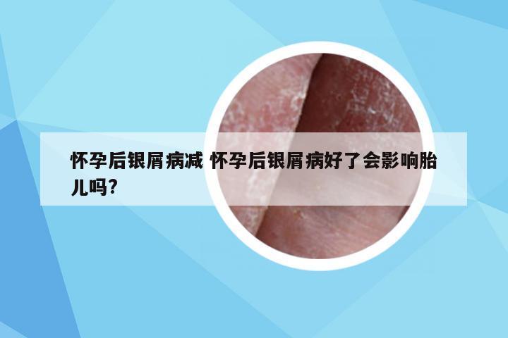 怀孕后银屑病减 怀孕后银屑病好了会影响胎儿吗?