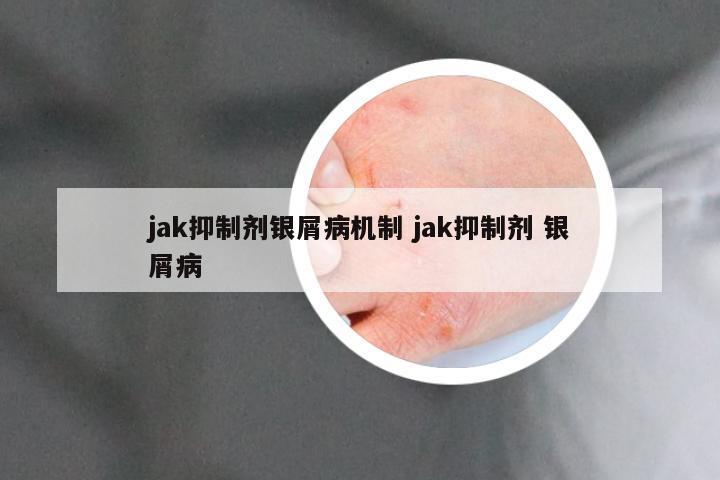 jak抑制剂银屑病机制 jak抑制剂 银屑病